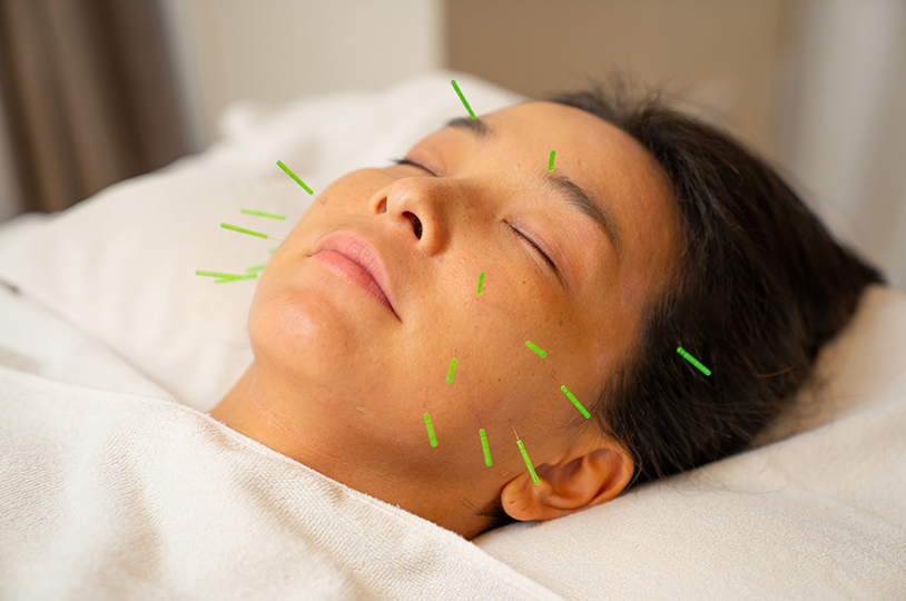 美容鍼で全身をゆるめる～脳のリラックス～